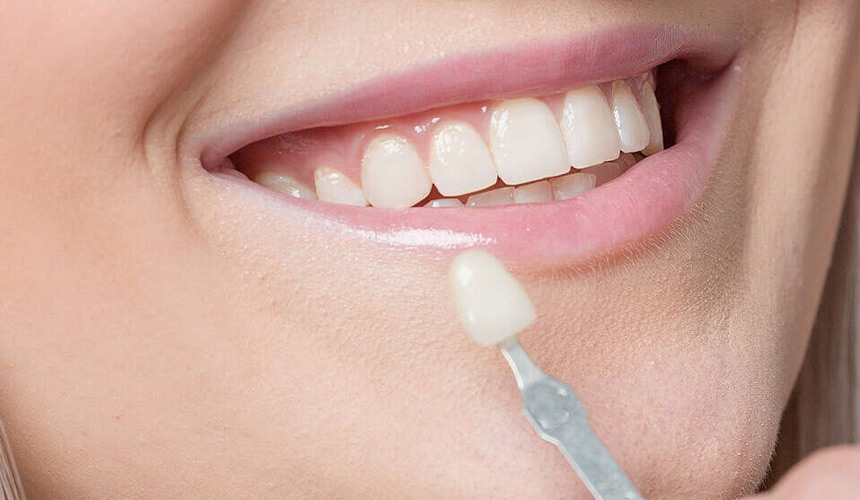 انواع برند لمینت دندان و مقایسه قیمت آن