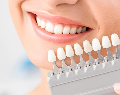 انواع برند لمینت دندان و مقایسه قیمت آن